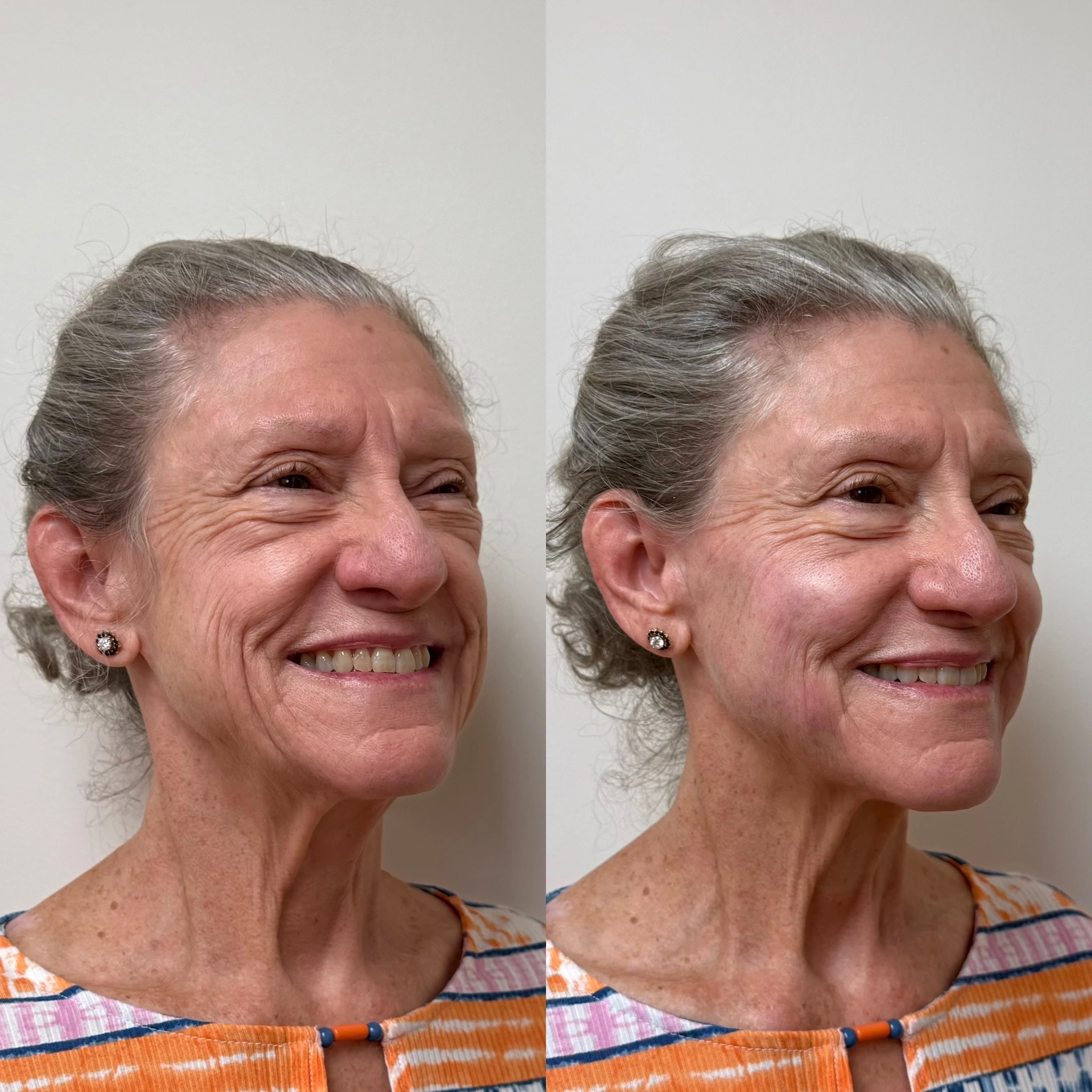 Sculptra — Before & After