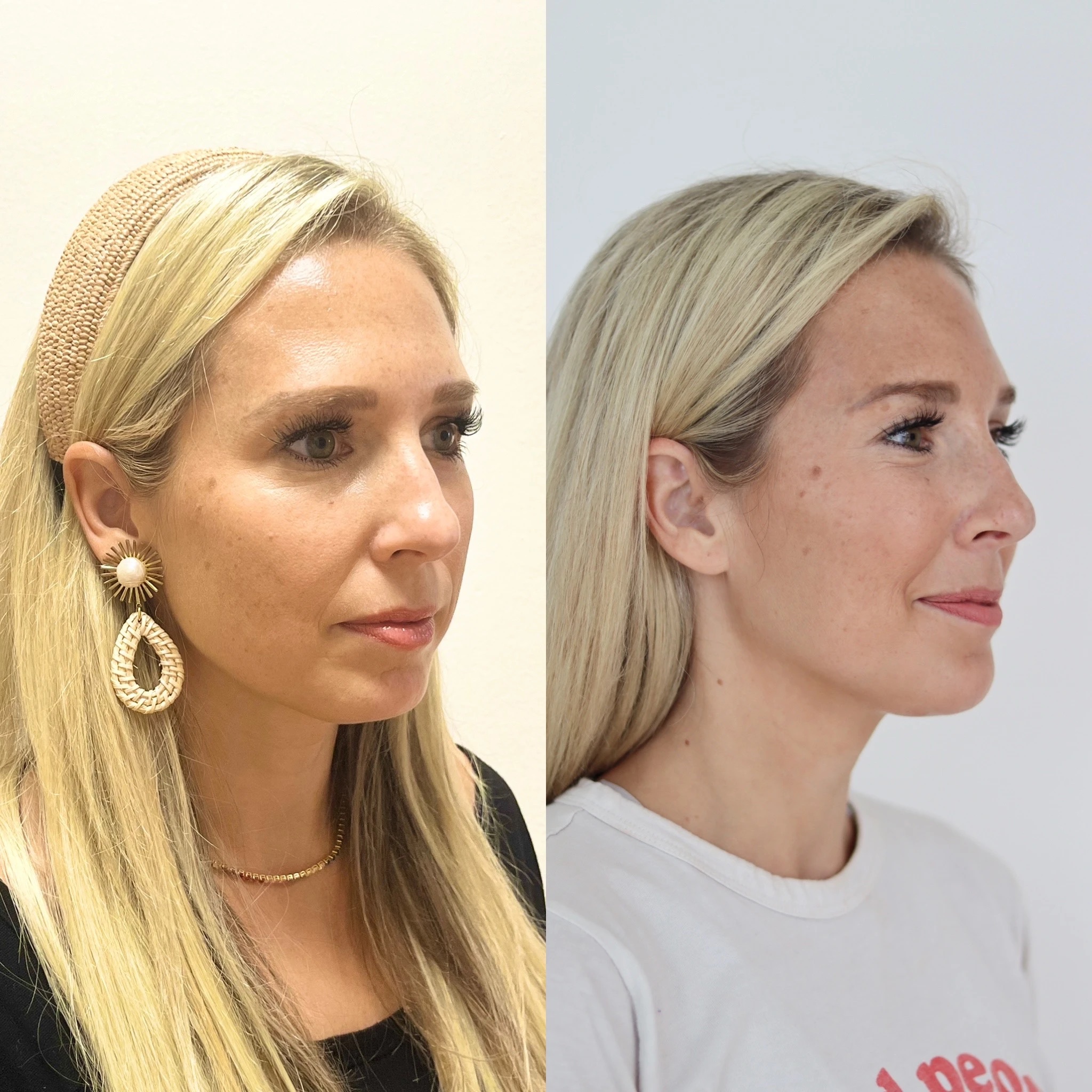 Filler — Before & After