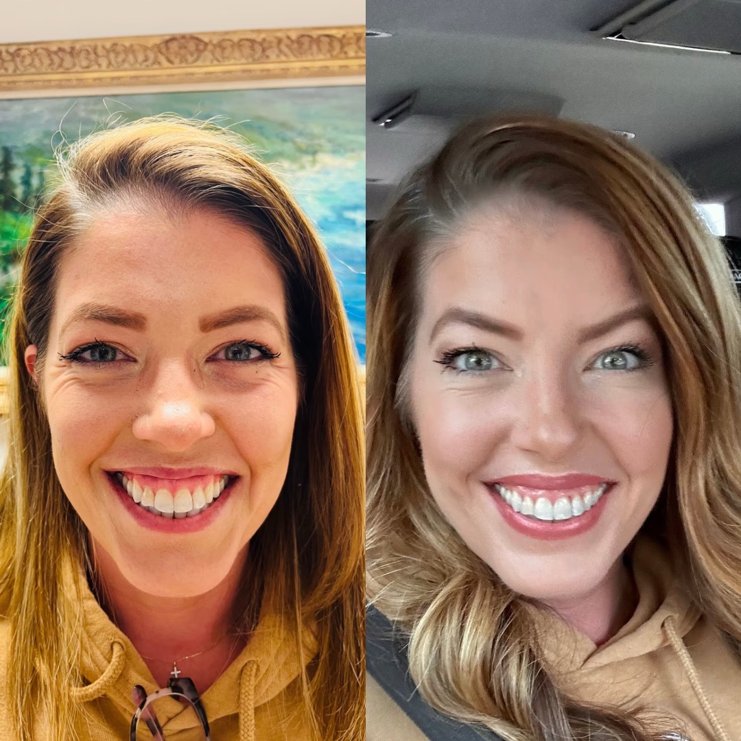 Botox — Before & After