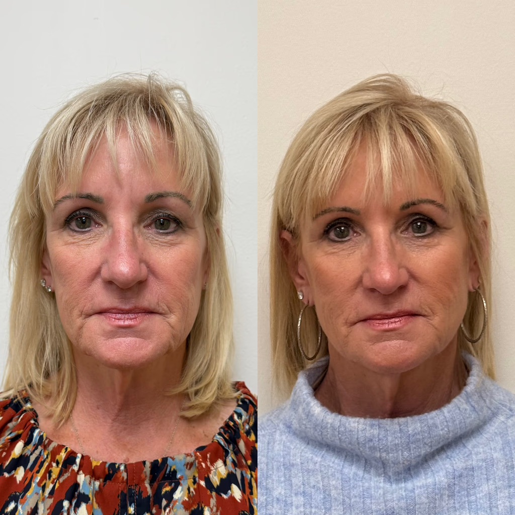 Sculptra — Before & After
