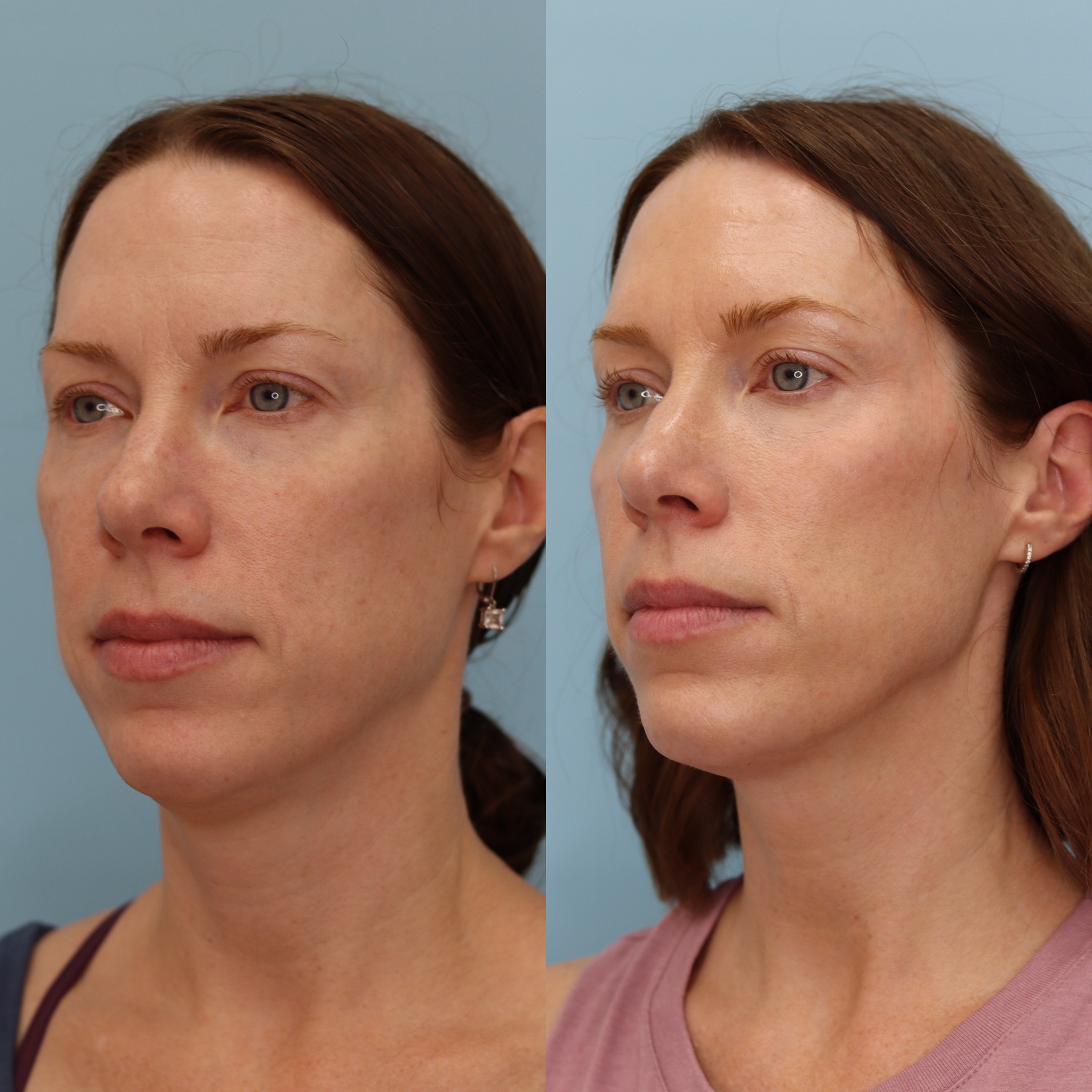 Sculptra — Before & After